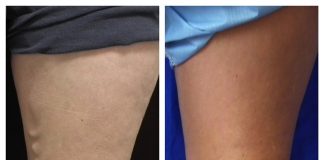 Vein Care e1497374790796