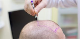 Hair Transplant