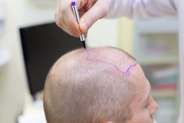 Top 10 Hair Transplant Clinics in the USA - Pouted.com