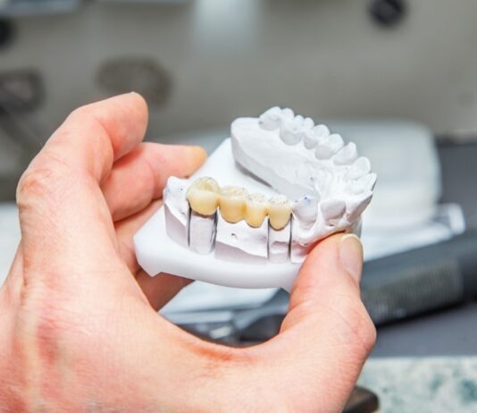 Dental Bridge vs Implant: Comparison