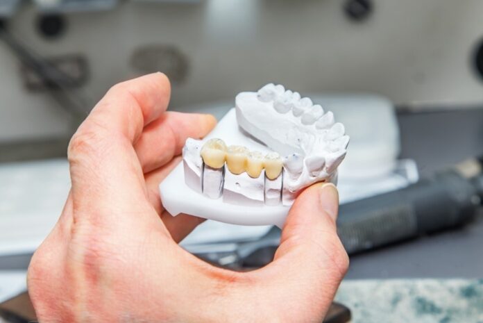 Dental Bridge vs Implant: Comparison
