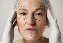 Deep Plane Facelift-What to know