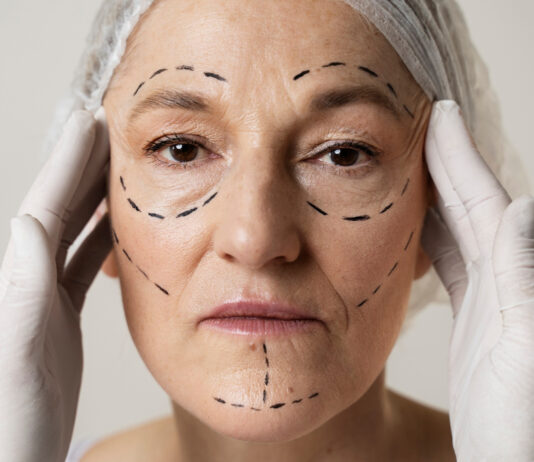 Deep Plane Facelift-What to know
