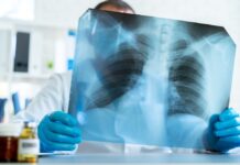 What to Know About Lung Cancer Linked to Asbestos Exposure What to Know About Lung Cancer