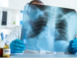 What to Know About Lung Cancer