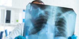 What to Know About Lung Cancer