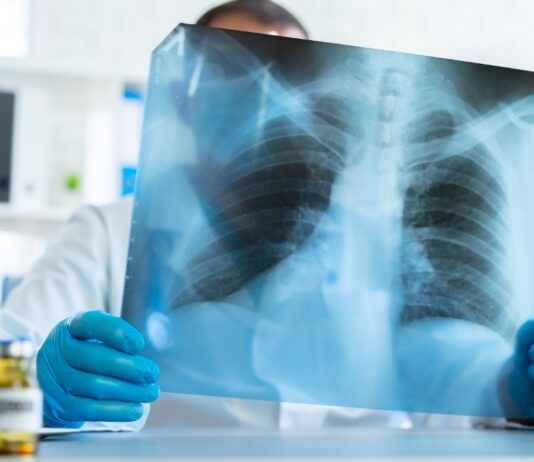 What to Know About Lung Cancer