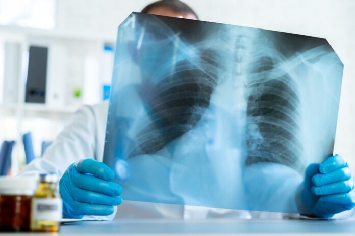 What to Know About Lung Cancer